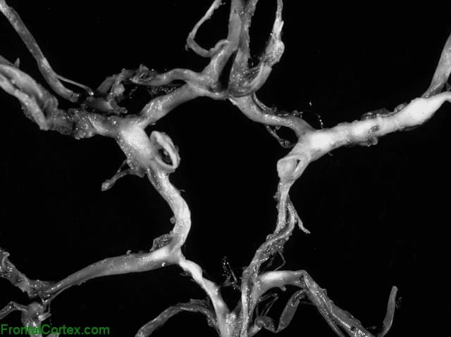 Circle of Willis, gross photographs of dissected arteries